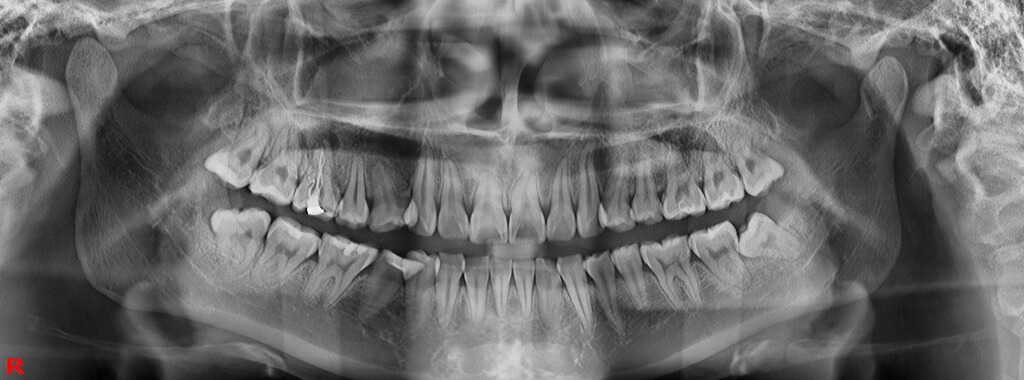 Dentitionmodus